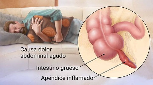 Apendicitis