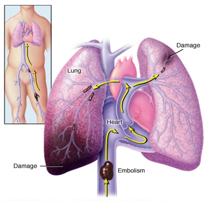 Tromboflebitis ALDIA Noticias de Los Ríos, Ecuador y el mundo