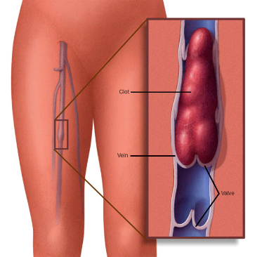 Tromboflebitis