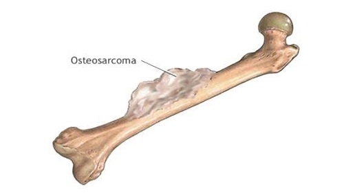 Cáncer de huesos una enfermedad de edad juvenil