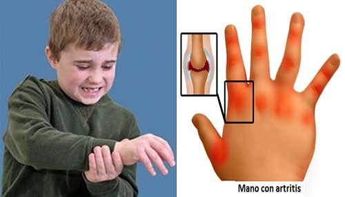 Artritis juvenil, la desconocida y dolorosa enfermedad que puede afectar a tu hijo sin que te des cuenta