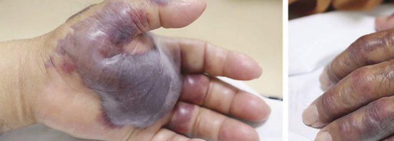 Una bacteria presente en el sushi provoca la amputación del brazo a un surcoreano