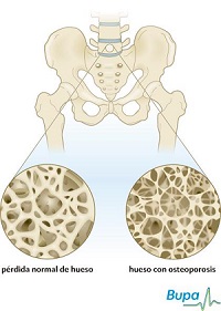 ‘Es un avance enorme’: Un tratamiento para osteoporosis que reduce las fracturas
