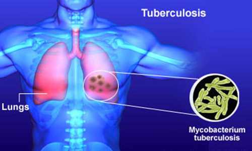 La tuberculosis es curable si se detecta a tiempo