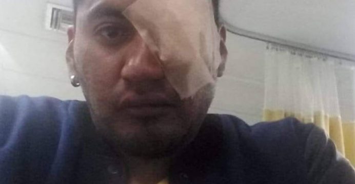 Joven corre riesgo de perder un ojo tras recibir impacto de bomba lacrimógena en protestas