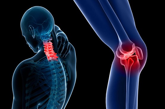 La osteoartritis afecta a millones de personas