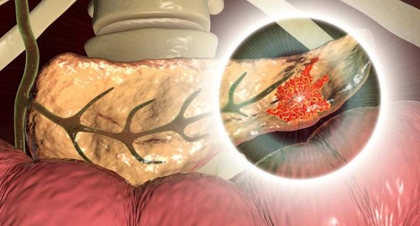 Tumores de Páncreas, descripción, epidemiología y reducción de riesgos